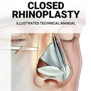 Offerta Speciale Closed rhinoplasty. Illustrated technical manual